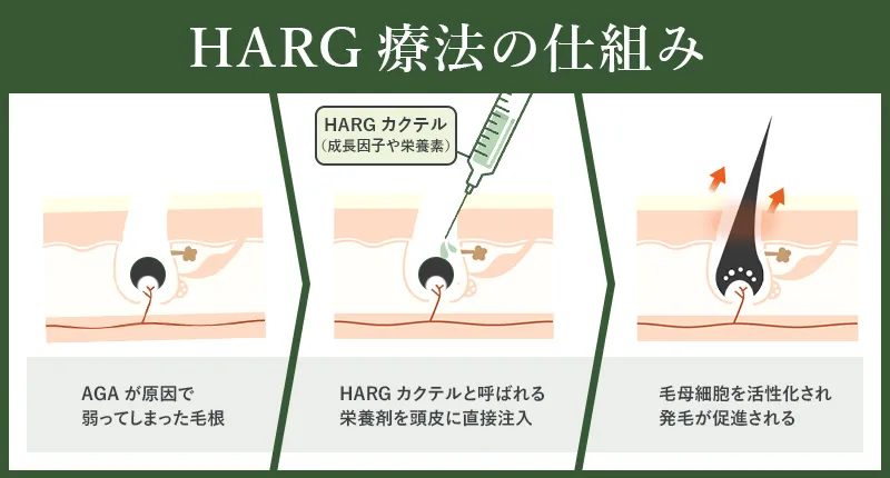 HARG療法の仕組み