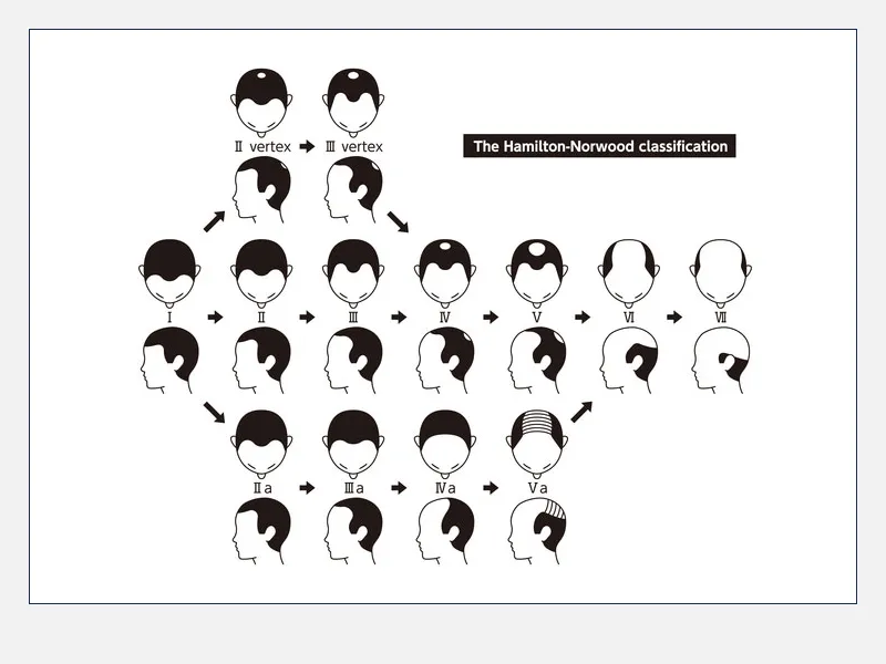 ハミルトンノーウッド分類によるAGA進行の図