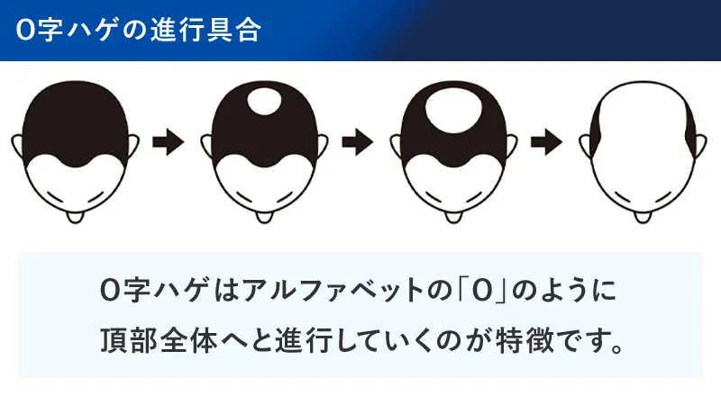 つむじはげの進行具合の図