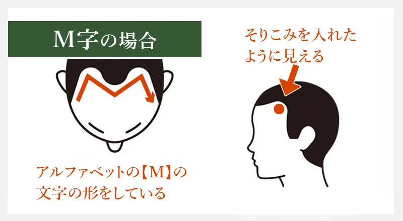 M字型の生え際の形や特徴