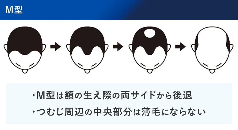 M字はげの進行具合の図