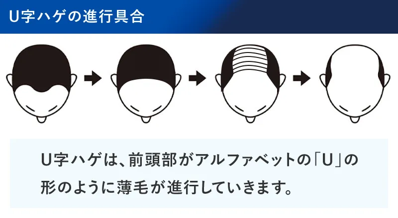 U字はげの進行具合の図