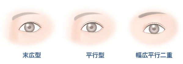 末広型/並行型/幅広並行二重