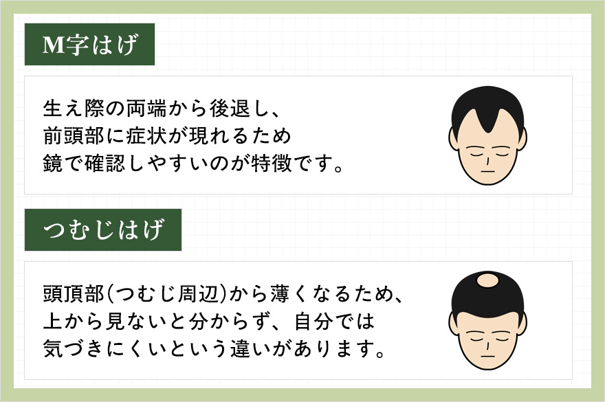 M字ハゲとつむじはげの特徴まとめ