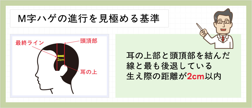 M字はげの進行の見極め