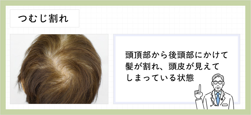 つむじ割れの説明の画像